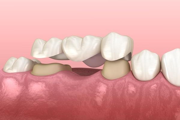 Understanding The Benefits Of Dental Bridge