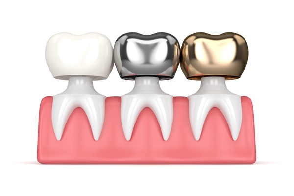 What Materials Are Dental Crowns Made Of?