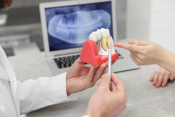 Ask A Dentist: Am I A Candidate For Dental Implants?