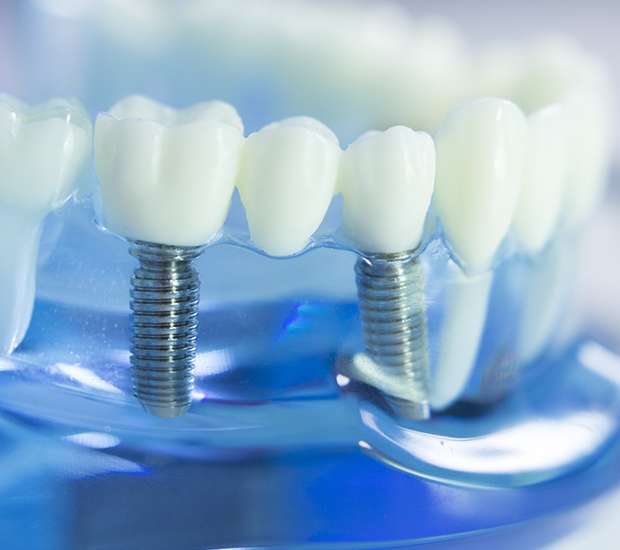 Danville Dental Implants