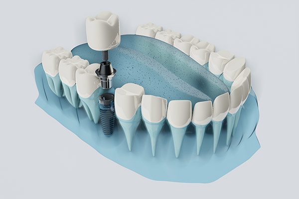 FAQs about Dental Implants from Gregory K. Louie DDS, PC in Danville, CA