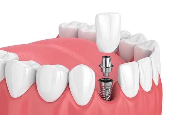 Mini vs. Regular Dental Implants from Gregory K. Louie DDS, PC in Danville, CA