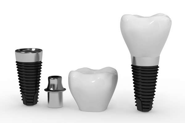 What Are the Parts of Dental Implants from Gregory K. Louie DDS, PC in Danville, CA
