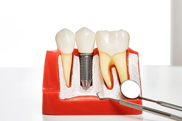 Your Guide to Different Kinds of Dental Implants from Gregory K. Louie DDS, PC in Danville, CA